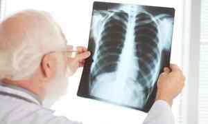 Жителей Северодвинска приглашают проверить здоровье лёгких