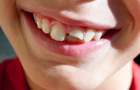 Сломанный зуб ученика обойдется котласской школе в 120 тысяч