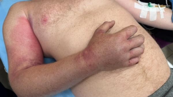 Пытался отсосать яд и пил таблетки: северянин едва не погиб после встречи со змеей Пытался отсосать яд и пил таблетки: северянин едва не погиб после встречи со змеей