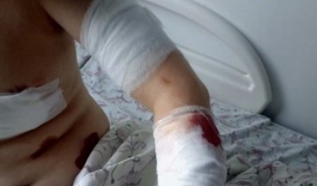 В Архангельской области лайка искусала мальчишку